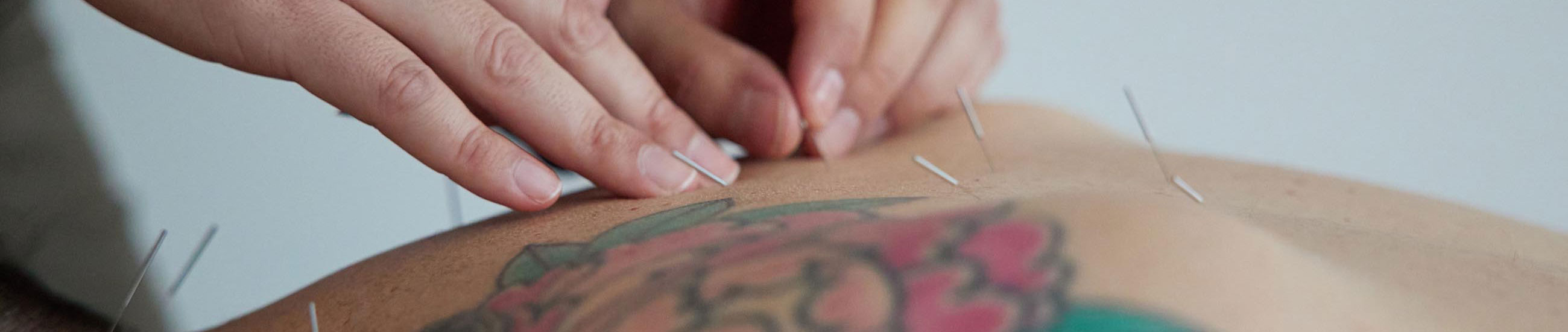 Acupuncture